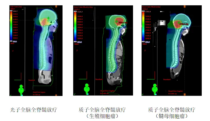 Three sagittal planning images comparing photon and proton craniospinal dose distributions
